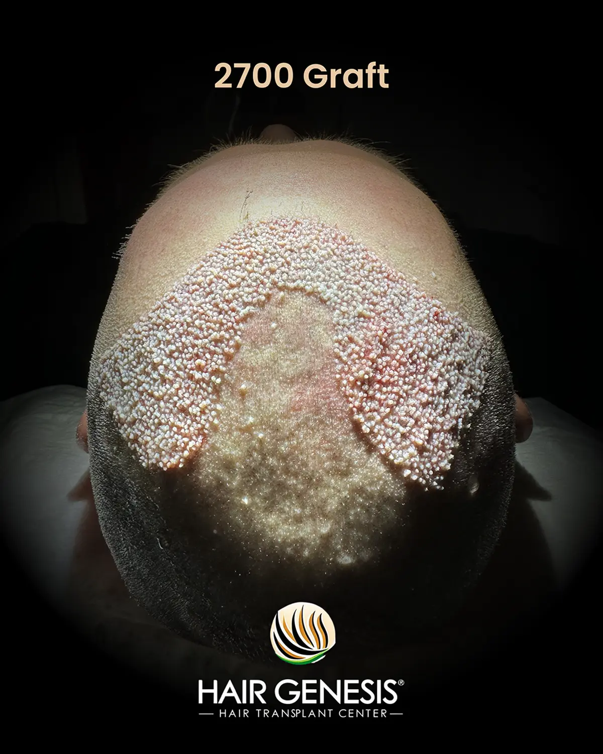 Hair Genesis - Stammzellentherapie