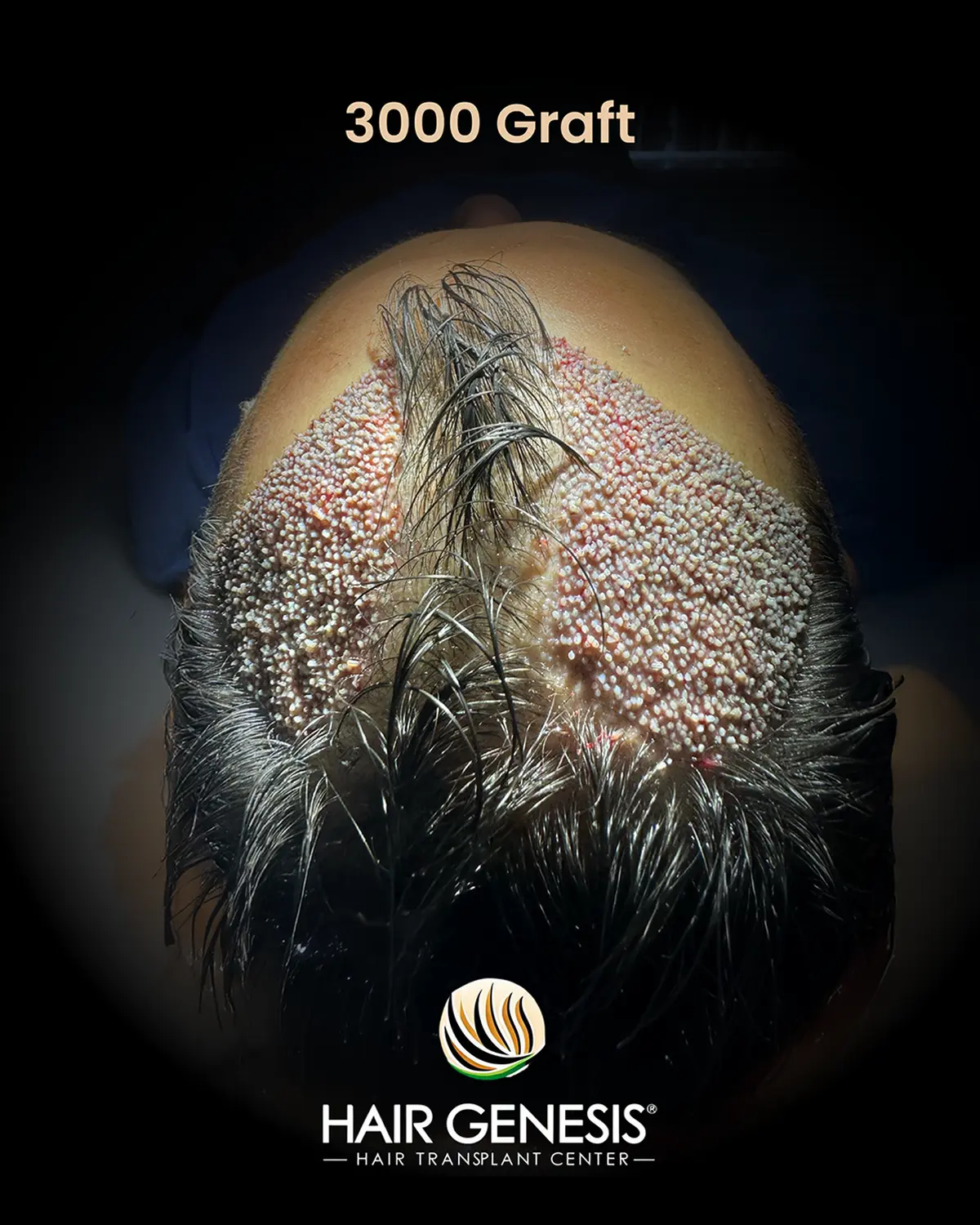 Hair Genesis - Stammzellentherapie