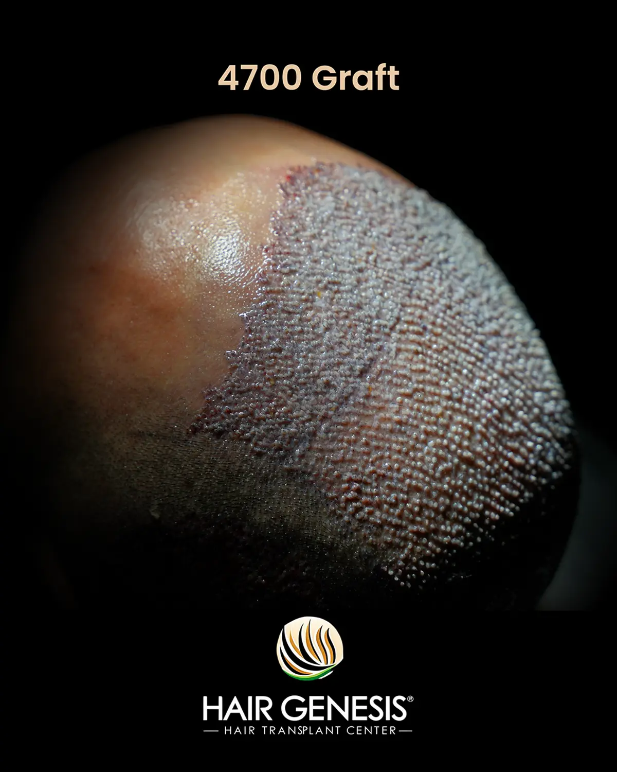 Hair Genesis - Stammzellentherapie