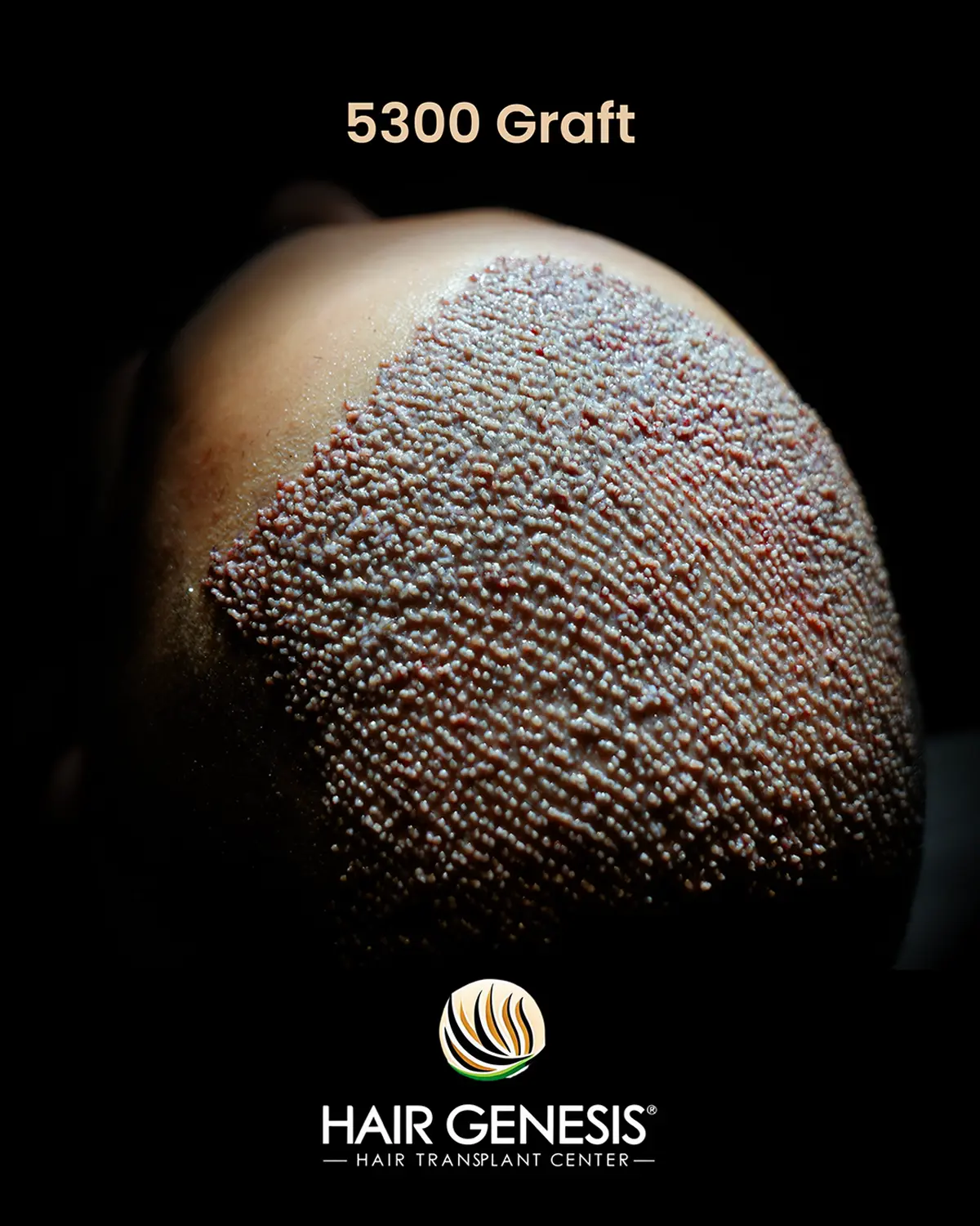 Hair Genesis - Stammzellentherapie