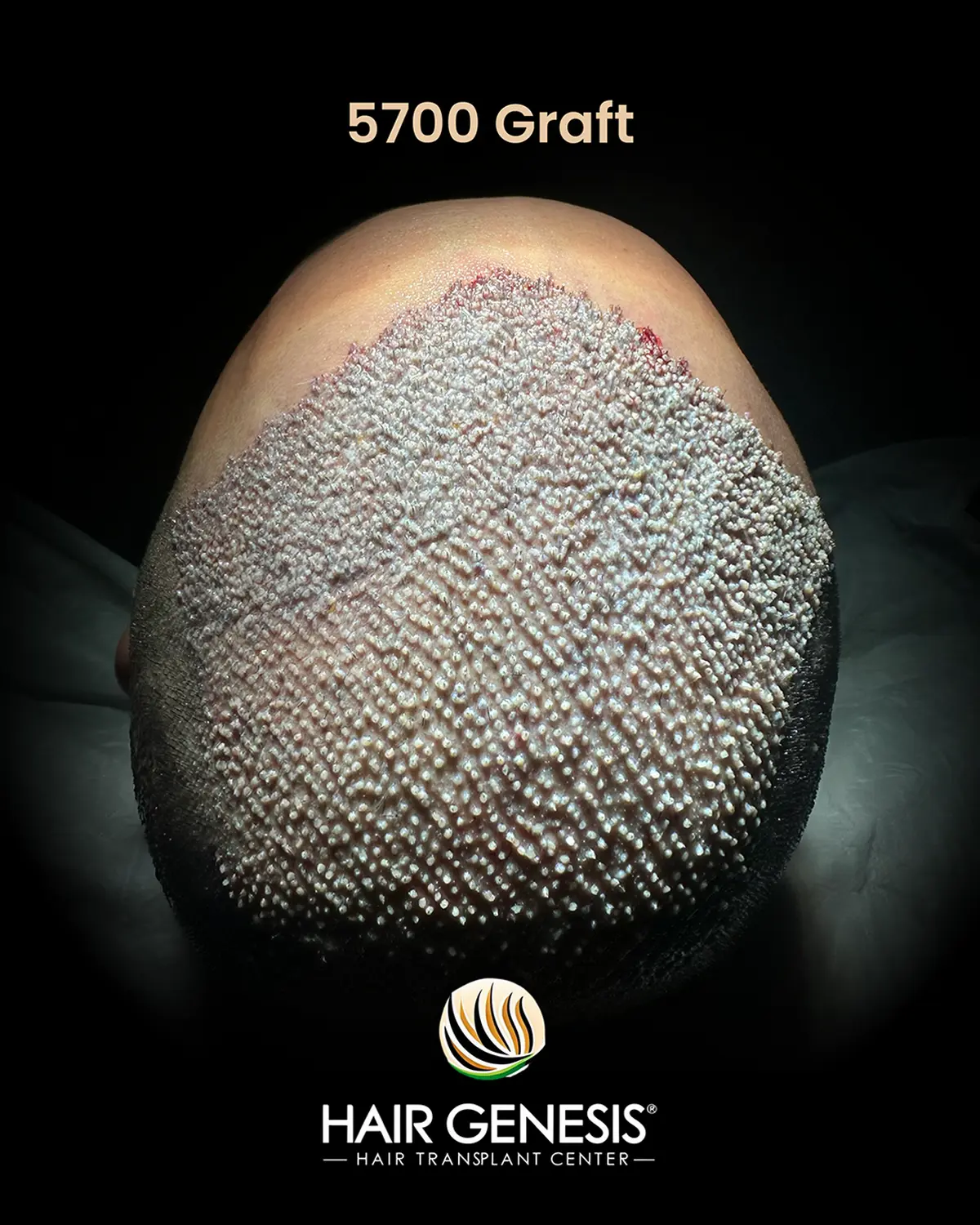 Hair Genesis - Stammzellentherapie