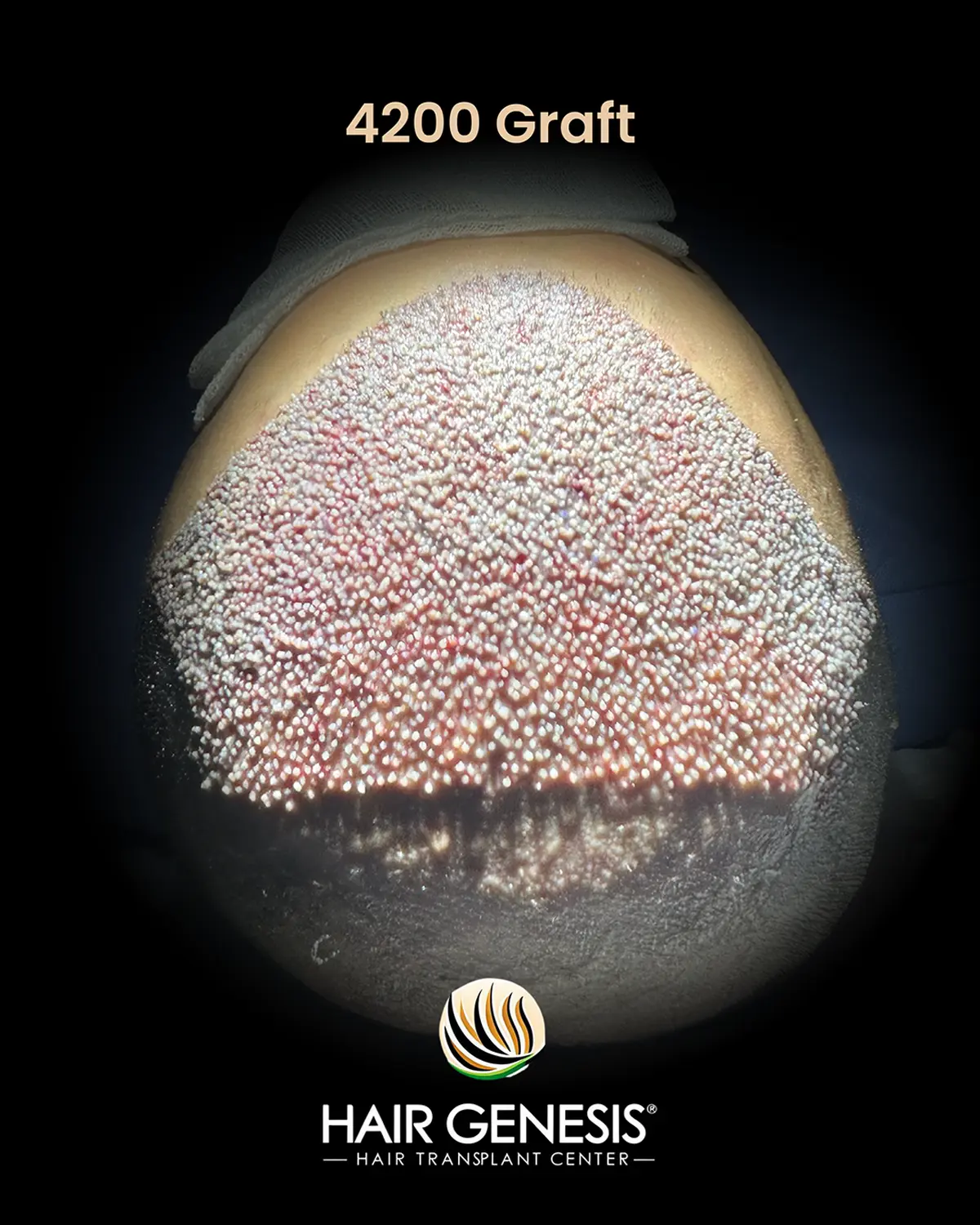 Hair Genesis - Stammzellentherapie